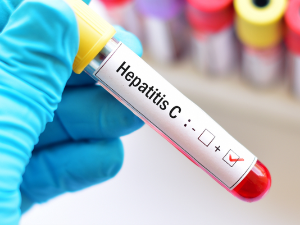 Хепатитис Ц је тешка болест која се лечи ако се открије на време