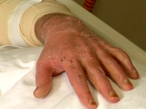 Довољан је секунд непажње да задобијемо опекотине опасне по живот