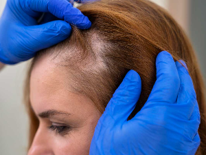 Алопеција, непредвидива аутоимуна болест која односи косу у печатима