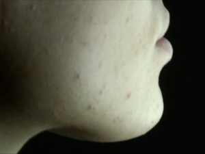 Од хроничне запаљенске болести коже пати углавном млађа популација