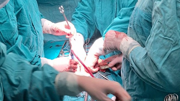 Тим ужичких уролога оборио европски рекорд – одстранили тумор простате тежак око пола килограма