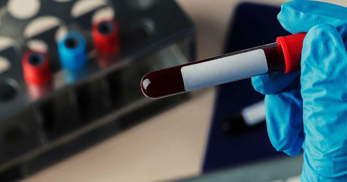 Осам сати без хране пре вађења крви – нова студија показује да то често није неопходно