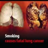 Шокантне слике одбијају пушаче од цигарете