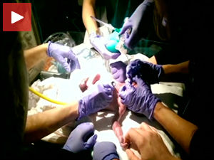 Новорођенчету успешно пресађено срце