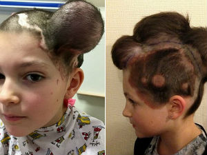 Балонима под скалпом узгајали нову кожу