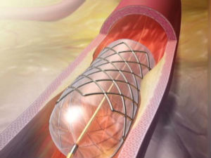 Због летњих температура повећан број уграђених стентова